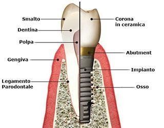 impianti dentali