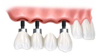 implantologia dentale