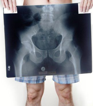 Persoon die een röntgenfoto van zijn bekken vasthoudt. Draagt ​​een blauw-wit geblokte korte broek.