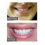 teeth whitening before and after shot