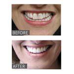 teeth before and after professional whitening