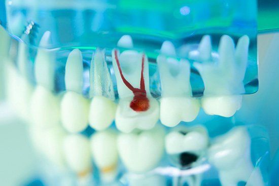 Root Canal therapy in Cicero, IL 60804