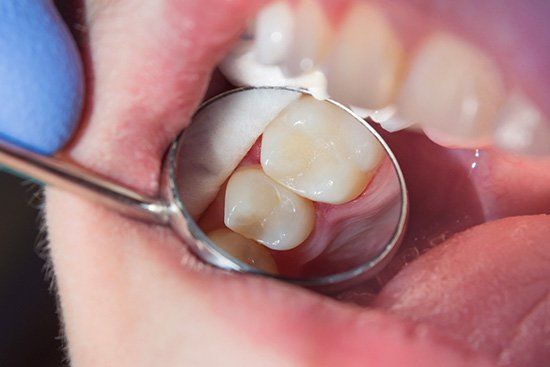 Seamless tooth-colored fillings in Cicero, IL 60804