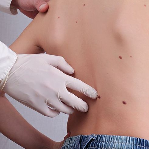 Skin Care  — Child with rash | Academic Dermatology Consultants of Long Island in Bethpage, NY