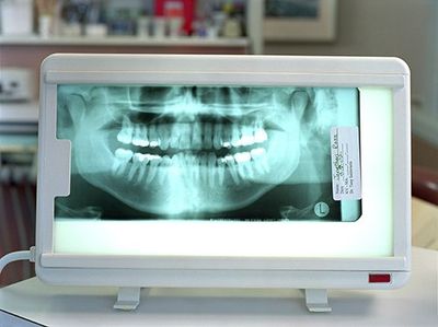 X-ray charts X-ray charts