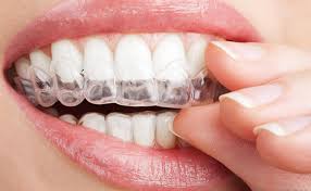 Teeth straightening