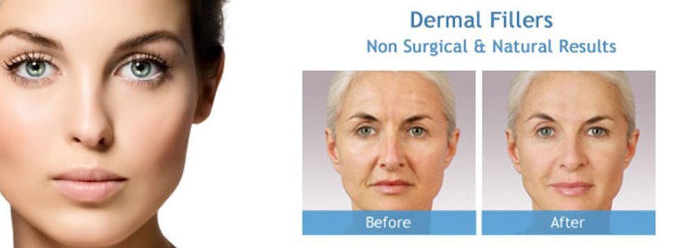 Dermal fillers