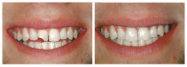 Fillings