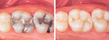 Fillings 2
