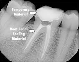 Root Fillings