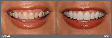 Veneers