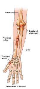 Kleiser Therapy Treats Arm and Elbow Fractures