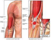Kleiser Therapy Treats Bicep Tendonitis, Ruptures or Tears