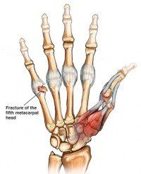 Kleiser Therapy Treats Boxers Fracture