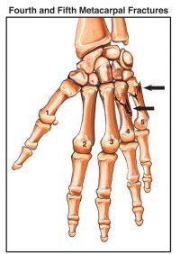 Kleiser Therapy Treats Finger and Hand Fractures