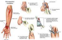 Kleiser Therapy Treats Pronator Syndrome