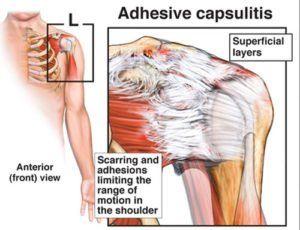 Kleiser Therapy Treats Frozen Shoulder