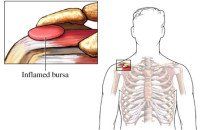 Kleiser Therapy Treats Bursitis and Tendinitis