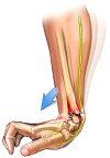 Kleiser Therapy Treats Colles Fractures