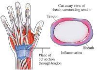 Kleiser Therapy Treats DeQuervain's Tenosynovitis