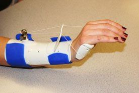 Kleiser Therapy Treats Flexor Tendon Repairs and Lacerations
