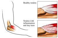 Kleiser Therapy Treats Tennis Elbow