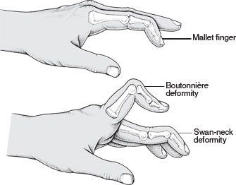 Kleiser Therapy Treats Mallet Finger