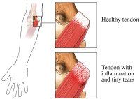 Kleiser Therapy Treats Golfers Elbow