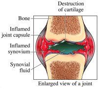 Kleiser Therapy Treats Rheumatoid Arthritis