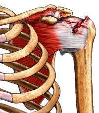 Kleiser Therapy Treats Rotator Cuffs