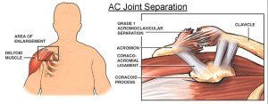 Kleiser Therapy Treats Shoulder Separation