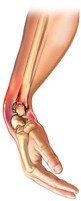 Kleiser Therapy Treats Smiths Fractures