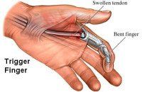 Kleiser Therapy Treats Trigger Finger