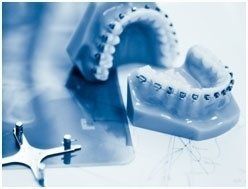 apparecchio fisso per i denti apparecchio fisso per i denti
