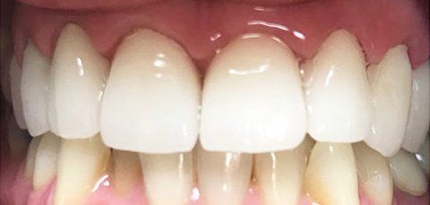 Close-up of a person's teeth; the teeth are white and well-aligned with pink gums.