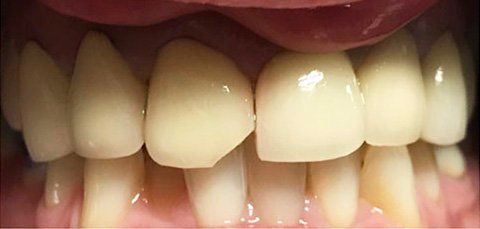 Close-up of a mouth showing teeth with a chipped front tooth, surrounded by pink gums.