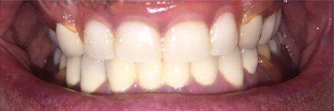 Close-up of teeth in a mouth, teeth are white and slightly yellow, gums are pink, mouth is open.