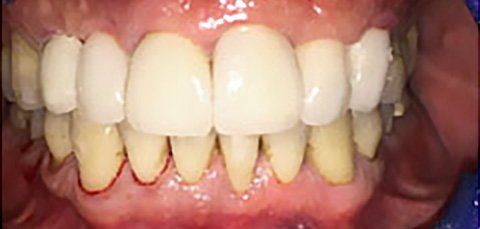Close-up of teeth. The upper teeth are white, and the lower are yellow with red gums.