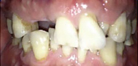 Close-up of a person's teeth, showing decay and cavities. Yellowish teeth and red gums are visible.