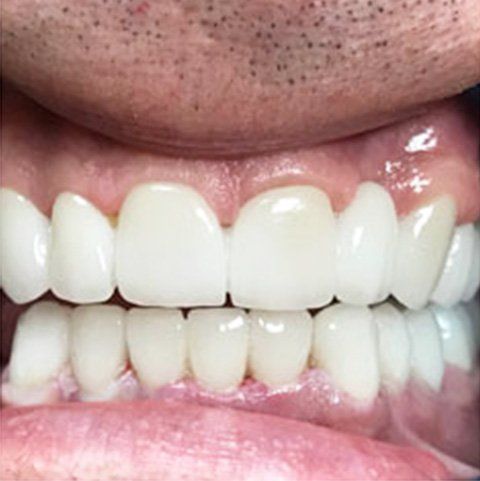 Close-up of a mouth with a bridge of white, flawless teeth.
