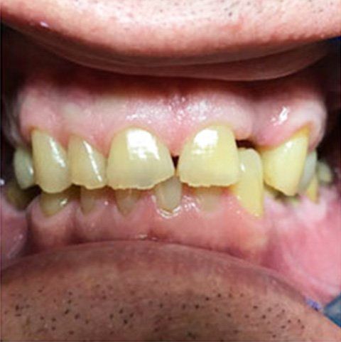 Close-up of mouth; yellowed teeth, some chipped, visible gums.
