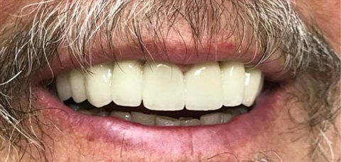 Close-up of a man's smiling mouth with new, bright-white teeth. Graying mustache and beard visible.