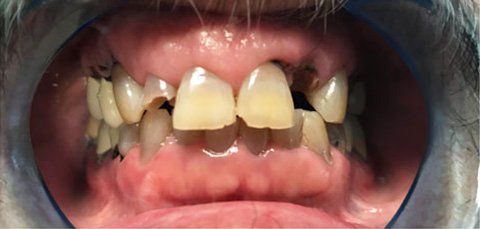Mouth with several yellow, chipped, and missing teeth, a dental examination.