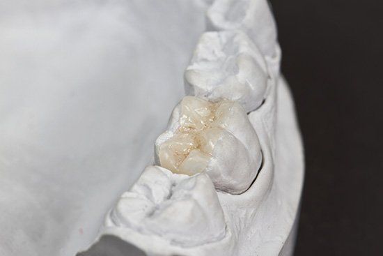 Dental model of teeth with a light-colored crown, set against a dark background.