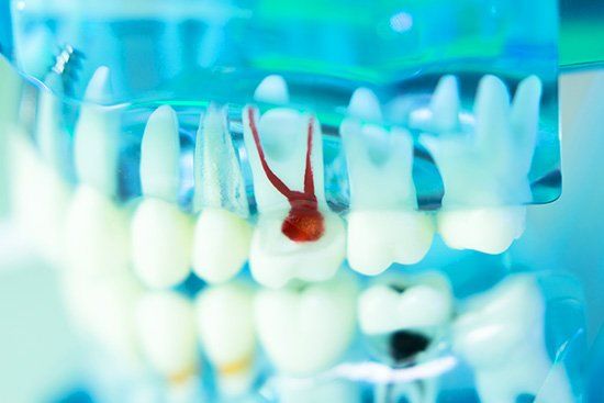 Dental model showing a tooth with exposed red root canals.