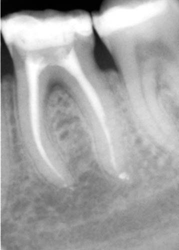 radiografia molari