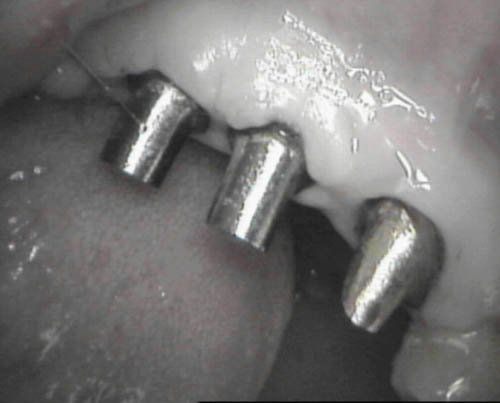 implantologia dentale