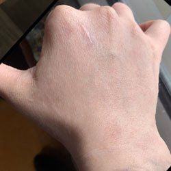 A close up of a person 's hand with a scar on it.