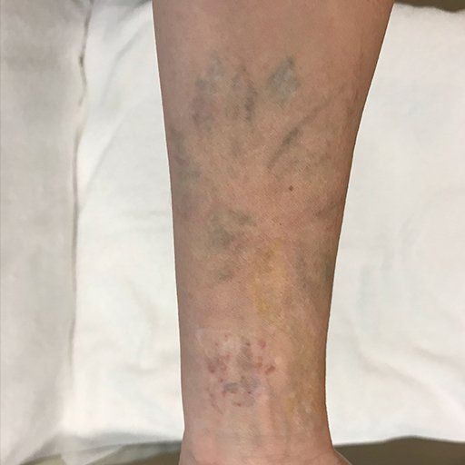 A close up of a person 's leg with varicose veins.