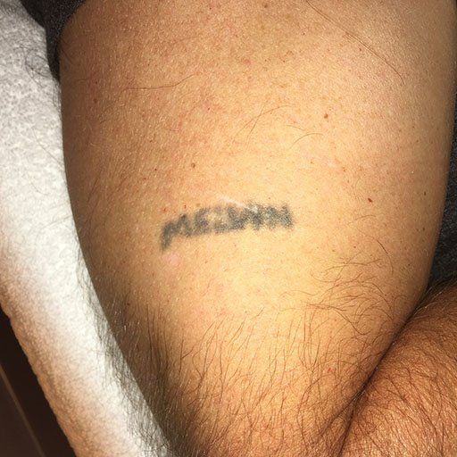 tattoo removal progress pictures